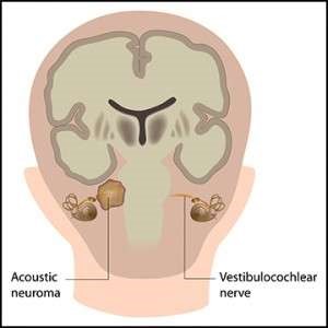 Acoustic Neuroma