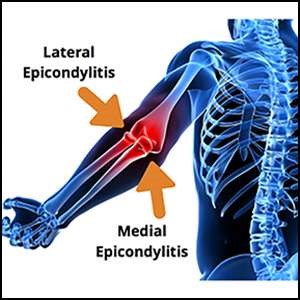 Epicondylitis (Tennis elbow/Golfer’s elbow)