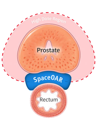 SpaceOARHydrogelProstateCancer-WithSpacer