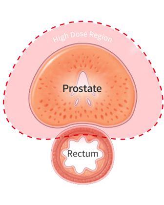 SpaceOARHydrogelProstateCancer-WithoutSpacer